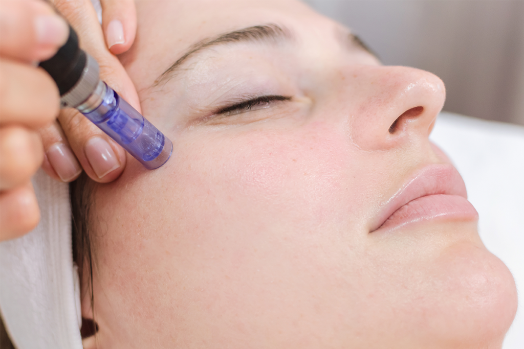 microneedling